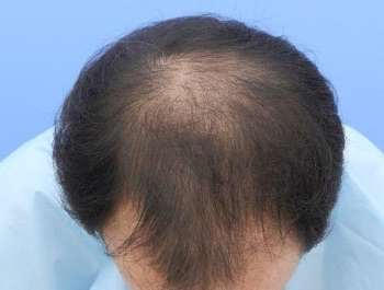 薄毛治療 発毛症例 48歳/MO型/初診時