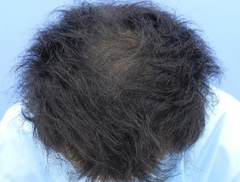 薄毛治療 発毛症例 27歳/O型/6ヶ月後