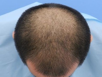 薄毛治療 発毛症例 33歳/O型/初診時