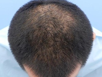 薄毛治療 発毛症例 33歳/O型/8ヶ月後