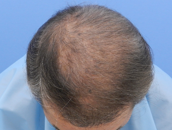 薄毛治療 発毛症例 65歳/O型/初診時