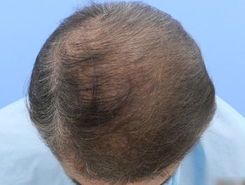 AGA治療例:65歳/O型/薄毛歴30年//5ヶ月後