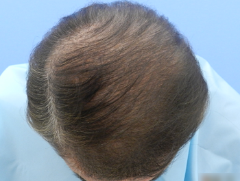 薄毛治療 発毛症例 65歳/O型/11ヶ月後