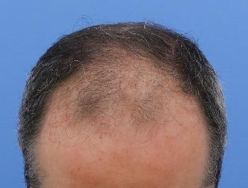 薄毛治療 発毛症例 46歳/M型/初診時