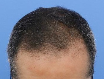 薄毛治療 発毛症例 46歳/M型/10ヶ月後