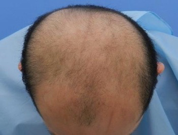 薄毛治療 発毛症例 36歳/MO型/初診時