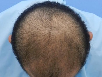 薄毛治療 発毛症例 36歳/MO型/5ヶ月後