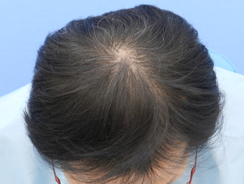 薄毛治療 発毛症例 50歳/MO型/11ヶ月後