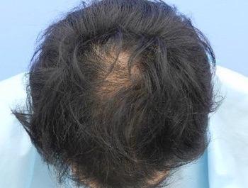 薄毛治療 発毛症例 40歳/MO型/9ヶ月後