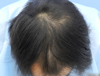 薄毛治療 発毛症例 34歳/MO型/9ヶ月後