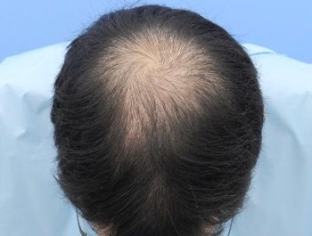 薄毛治療 発毛症例 31歳/O型/初診時
