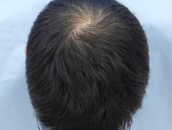 薄毛治療 発毛症例 31歳/O型/5ヶ月後