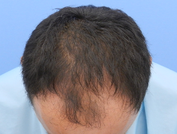 薄毛治療 発毛症例 48歳/M型/初診時