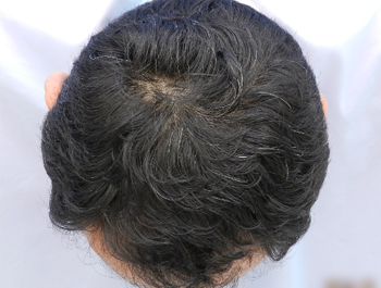 薄毛治療 発毛症例 48歳/M型/8ヶ月後