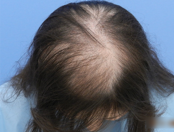 薄毛治療 発毛症例 27歳/頭頂部/初診時