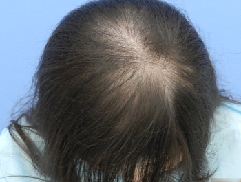 薄毛治療 発毛症例 27歳/頭頂部/12ヶ月後