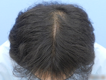 薄毛治療 発毛症例 38歳/O型/11ヶ月後