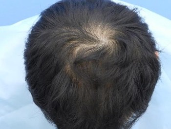 薄毛治療 発毛症例 35歳/MO型/6ヶ月後