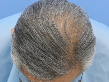 AGA治療例:65歳/O型/薄毛歴1年//8ヶ月後