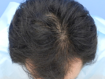 薄毛治療 発毛症例 42歳/MO型/7ヶ月後