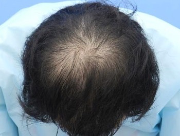 薄毛治療 発毛症例 24歳/O型/初診時
