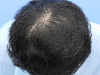 薄毛治療 発毛症例 24歳/O型/6ヶ月後