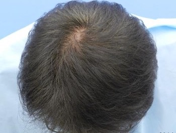 薄毛治療 発毛症例 50歳/O型/5ヶ月後