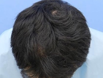 薄毛治療 発毛症例 26歳/MO型/6ヶ月後