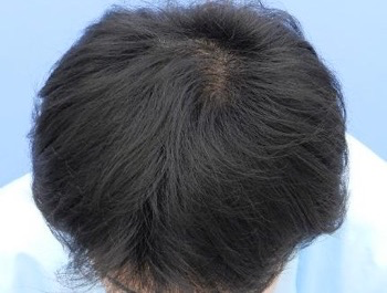 薄毛治療 発毛症例 47歳/O型/6ヶ月後