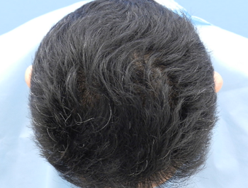 薄毛治療 発毛症例 49歳/O型/7ヶ月後