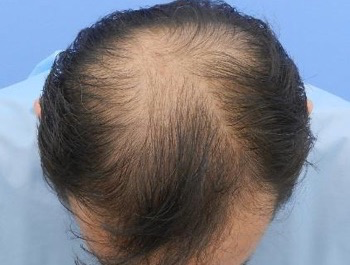 薄毛治療 発毛症例 54歳/MO型/初診時
