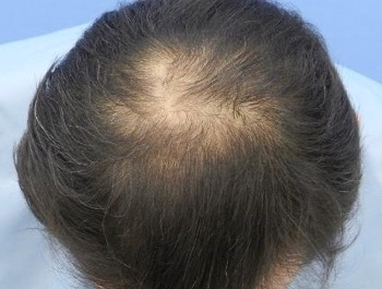 薄毛治療 発毛症例 54歳/MO型/6ヶ月後