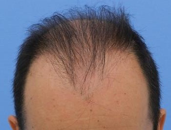薄毛治療 発毛症例 49歳/M型/初診時