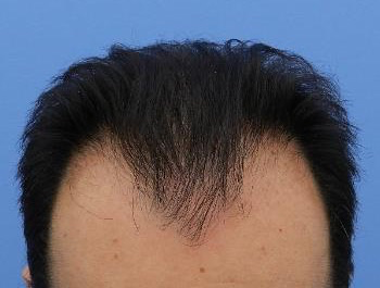 薄毛治療 発毛症例 49歳/M型/7ヶ月後