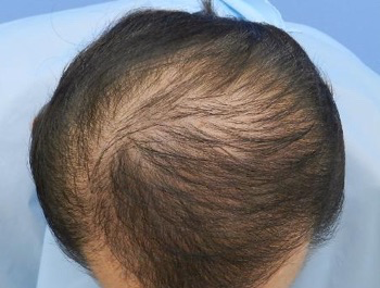 薄毛治療 発毛症例 61歳/MO型/6ヶ月後