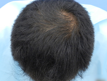 薄毛治療 発毛症例 46歳/MO型/9ヶ月後