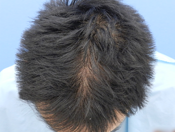 薄毛治療 発毛症例 38歳/O型/7ヶ月後
