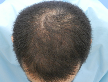 薄毛治療 発毛症例 30歳/MO型/10ヶ月後