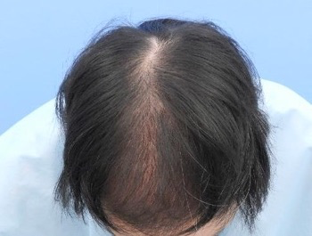 薄毛治療 発毛症例 32歳/MO型/初診時