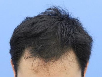 薄毛治療 発毛症例 40歳/M型/7ヶ月後