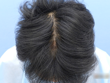 薄毛治療 発毛症例 32歳/O型/7ヶ月後