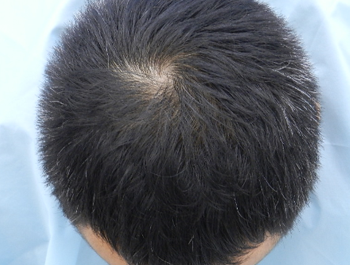 薄毛治療 発毛症例 34歳/MO型/12ヶ月後