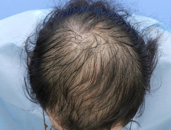薄毛治療 発毛症例 42歳/MO型/初診時