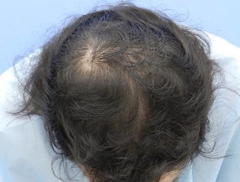 薄毛治療 発毛症例 42歳/MO型/6ヶ月後