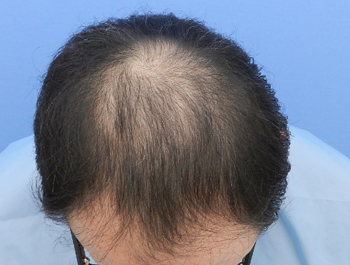 薄毛治療 発毛症例 41歳/MO型/初診時