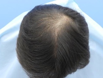 薄毛治療 発毛症例 47歳/O型/初診時