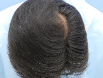 薄毛治療 発毛症例 47歳/O型/8ヶ月後