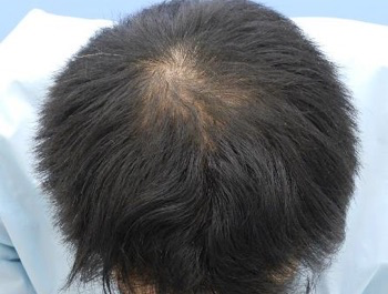 薄毛治療 発毛症例 33歳/O型/11ヶ月後