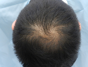 薄毛治療 発毛症例 23歳/O型/初診時