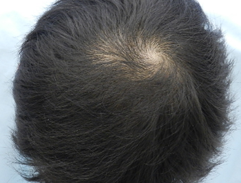 薄毛治療 発毛症例 23歳/O型/12ヶ月後